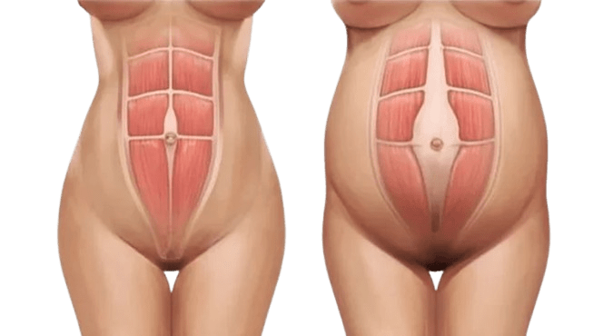 plano de saúde cobre cirurgia de diástase