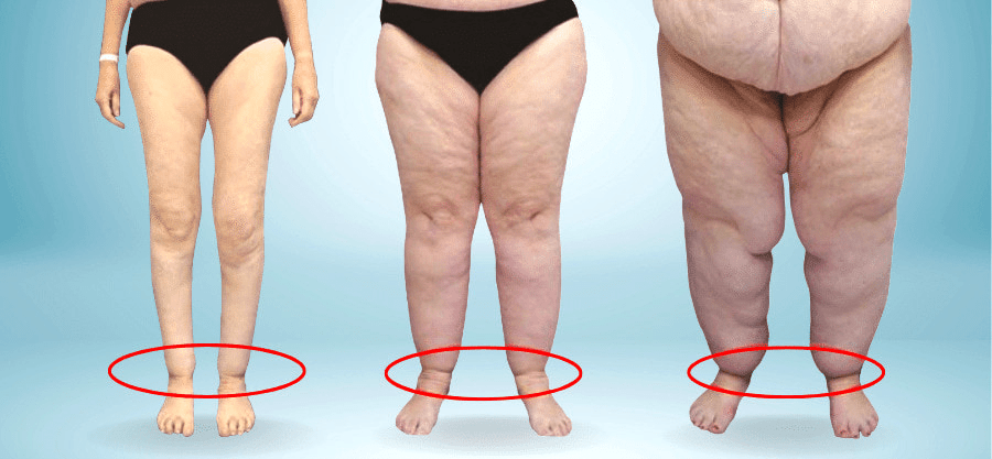 plano de saúde cobre cirurgia para lipedema