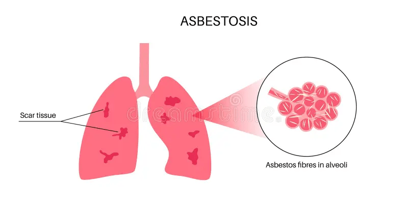 asbestose