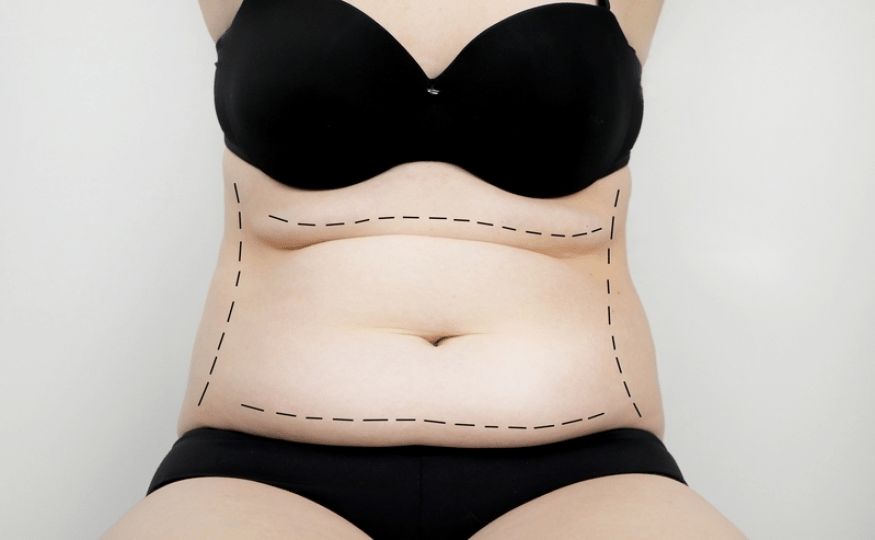Dermolipectomia abdominal