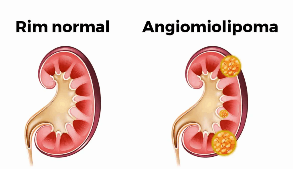 angiomiolipoma