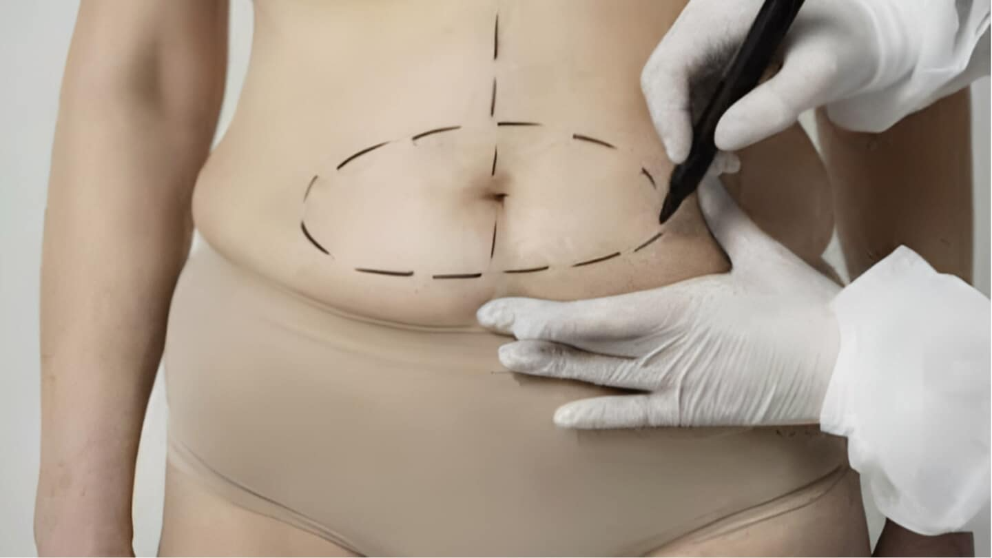 plano de saúde cobre lipoaspiração